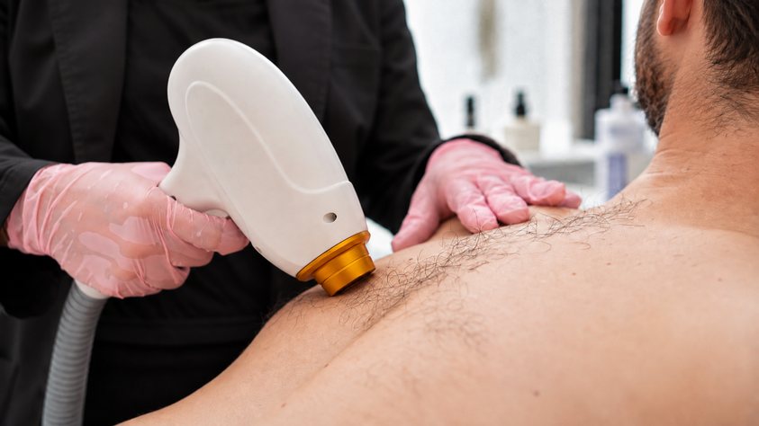 Test d'épilation laser sur l'épaule d'un homme, soin Test laser de Biostem